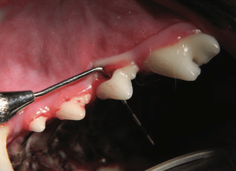 Painful occlusal trauma